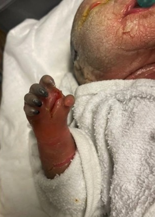 schowardjd's tweet photo. A 27-year-old G5P4 woman at 35 weeks 1 day gestation presented w/ preterm premature rupture of membranes. The pregnancy was complicated by consanguinity, w/ both parents being first cousins. Family hx was notable for a prior neonate who died 45 days after birth from an unspecified skin disorder; three other children were healthy.

At birth, the neonate had thick, plate-like hyperkeratotic plaques separated by deep erythematous fissures, severe acral edema w/ constrictive bands causing claw-like deformities & distal dusky discoloration concerning for ischemia, & B/L upper/lower eyelid ectropion, eclabium, flattened nasal bridge, & absent eyelashes & eyebrows. 

What’s the diagnosis❓