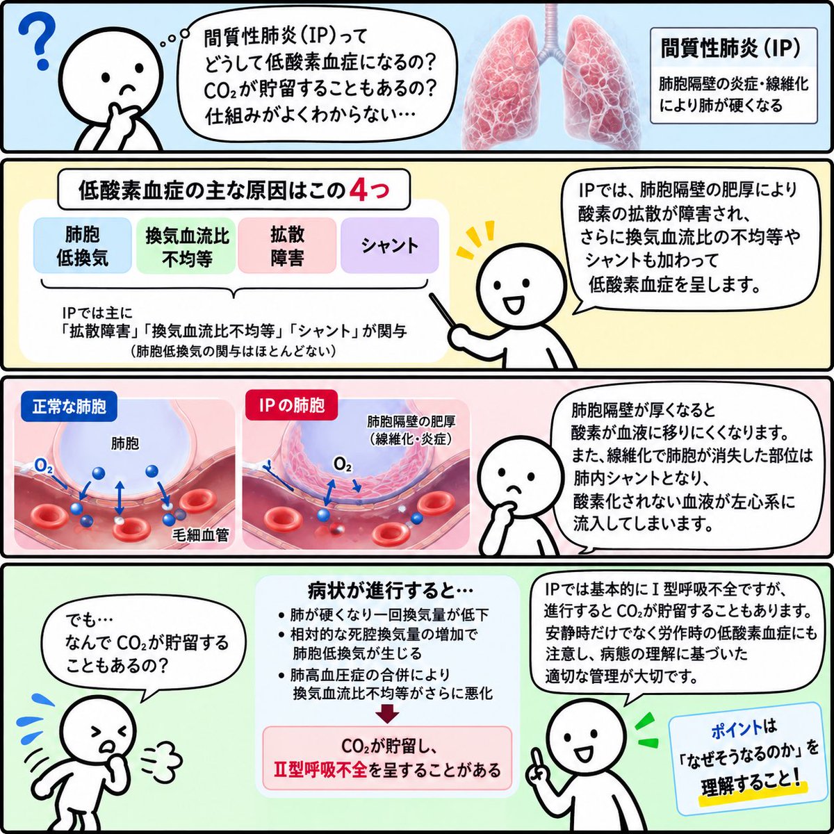 respidoctor2025's tweet photo. 間質性肺炎（IP）でSpO₂が低いのに、CO₂は上がらないのはなぜ？

低酸素血症には主に「拡散障害・換気血流比不均等・シャント」が関与します。

一方、進行して浅く速い呼吸となり、肺胞換気が不足するとCO₂が貯留することも。

https://t.co/MRK37djorG

#間質性肺炎 #呼吸生理 https://t.co/XKT25PLRyr