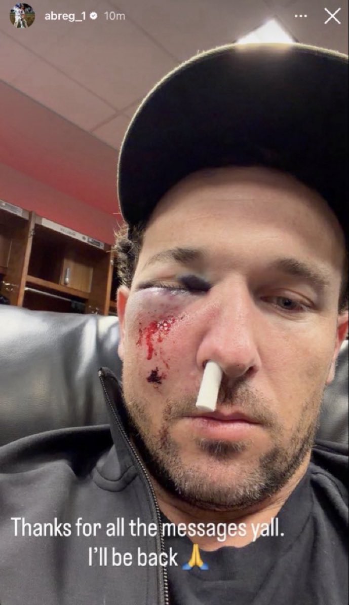 JDAWG_XV's tweet photo. @JomboyMedia Update on his face…😬 https://t.co/mubUsbEmtB