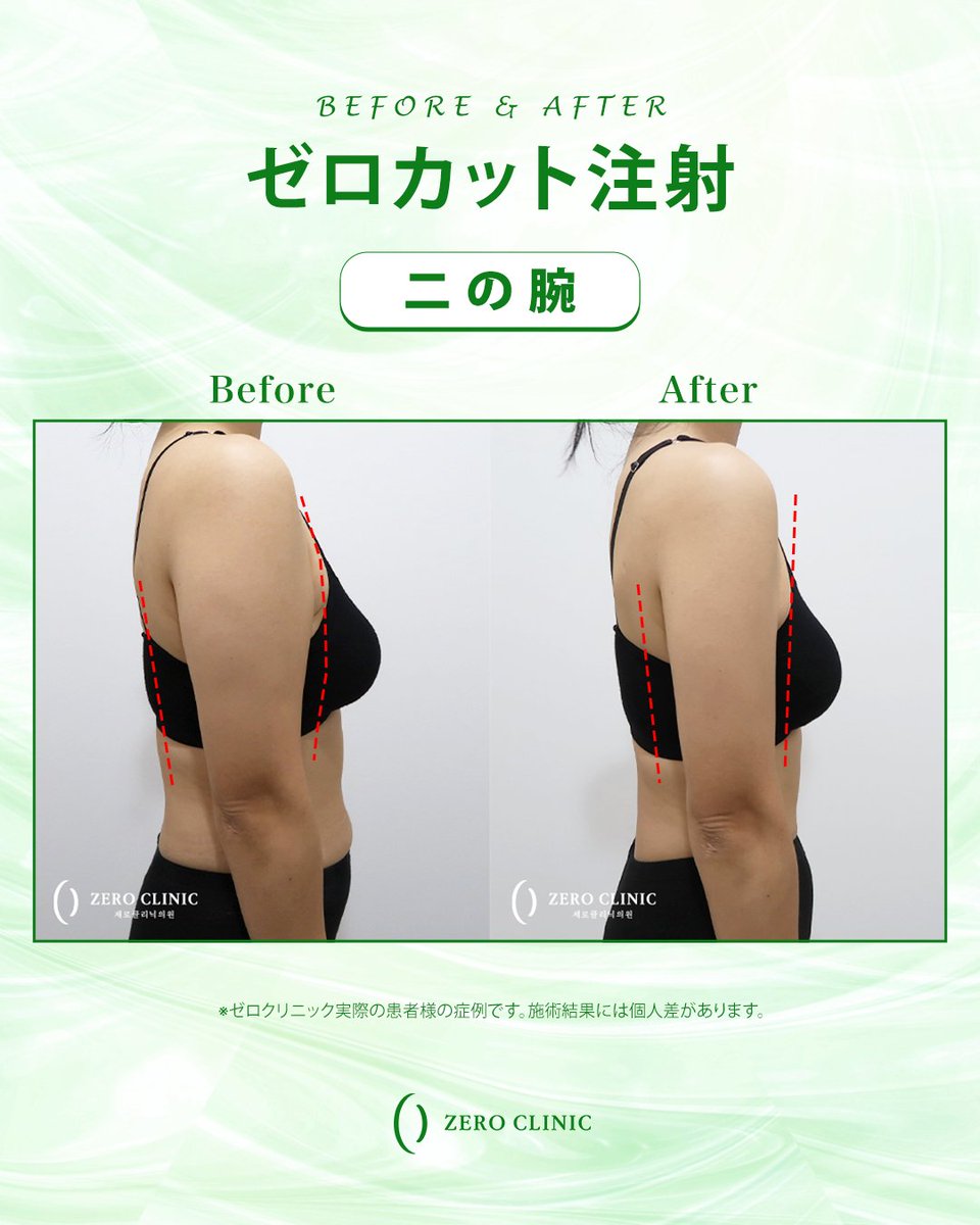 zeroclinic_jp's tweet photo. 📷ゼロクリニック 𝐁𝐞𝐟𝐨𝐫𝐞 & 𝐀𝐟𝐭𝐞𝐫

施術メニュー：ゼロカット注射
施術部位：二の腕

二の腕の外側のボリュームにアプローチ✨
気になっていた腕まわりがすっきりした印象に。
ノースリーブも楽しみたい方におすすめの施術です。

※施術結果には個人差があります。

ご予約・ご相談は公式LINEまで📧
⇨https://t.co/FaoKRuvD6N

#韓国美容 #韓国情報 #二の腕痩せ #韓国クリニック #美容医療
