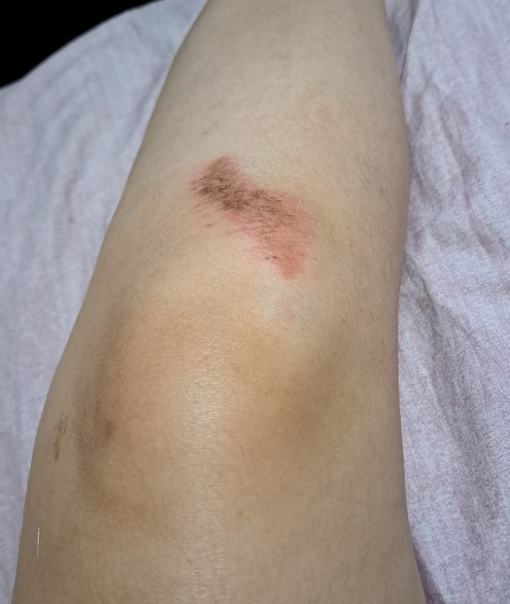 Vanillacream20_'s tweet photo. @Detranquis13 La verdad es muy divertido, los golpes son lo de menos la verdad. Ojalá puedas aprender, lo recomiendo aunque es algo difícil al principio
Mi rodilla quedó asi(ignoren los pelos): https://t.co/9IbxCD41zK