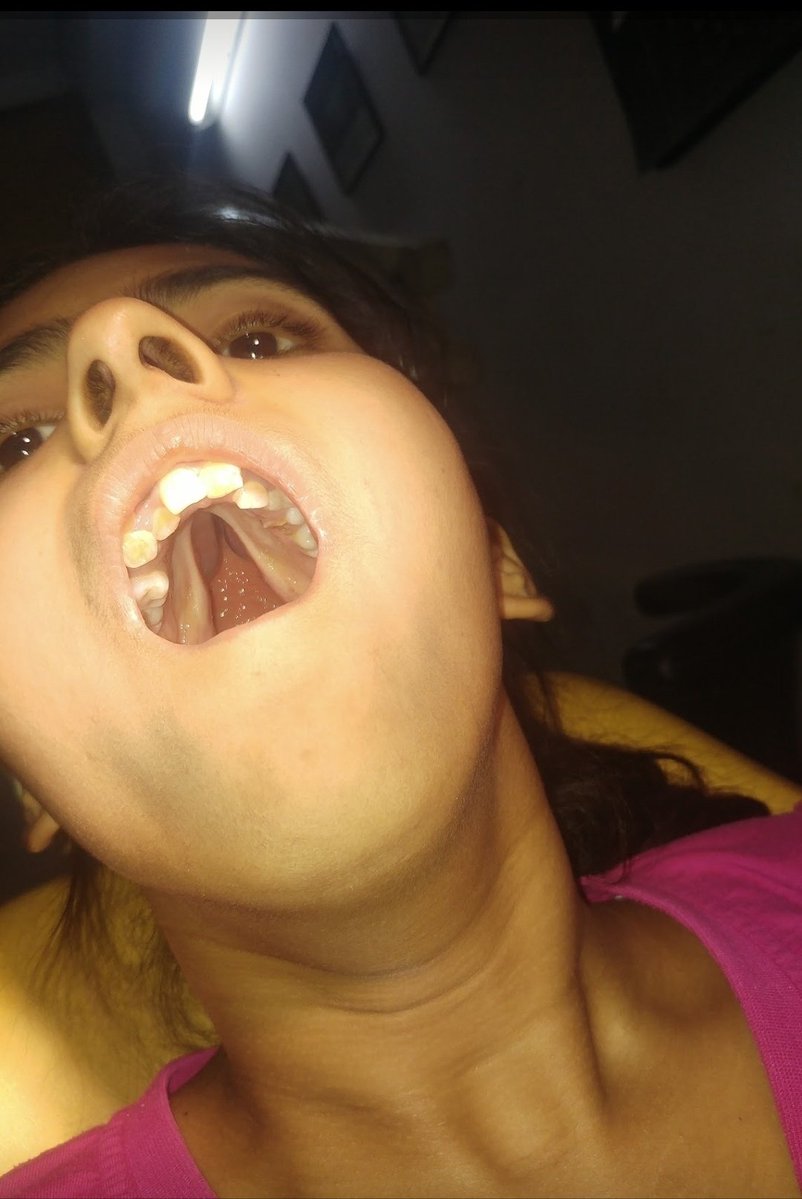 Doxing_7's tweet photo. Cleft Palate Obturator 🦷✨
An obturator is more than just a prosthesis—it creates a functional bridge where anatomy has left a gap.
By closing the palatal defect, it can help a cleft-palate patient with feeding, swallowing, speech, and separation of the oral and nasal cavities.
For many children, it becomes an important aid while they await definitive surgical correction. 
#Cleftlip #Cleftpalate