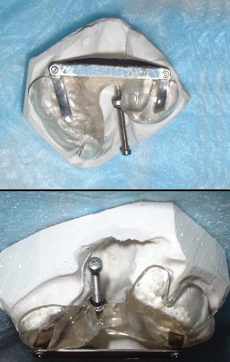 Doxing_7's tweet photo. Cleft Palate Obturator 🦷✨
An obturator is more than just a prosthesis—it creates a functional bridge where anatomy has left a gap.
By closing the palatal defect, it can help a cleft-palate patient with feeding, swallowing, speech, and separation of the oral and nasal cavities.
For many children, it becomes an important aid while they await definitive surgical correction. 
#Cleftlip #Cleftpalate