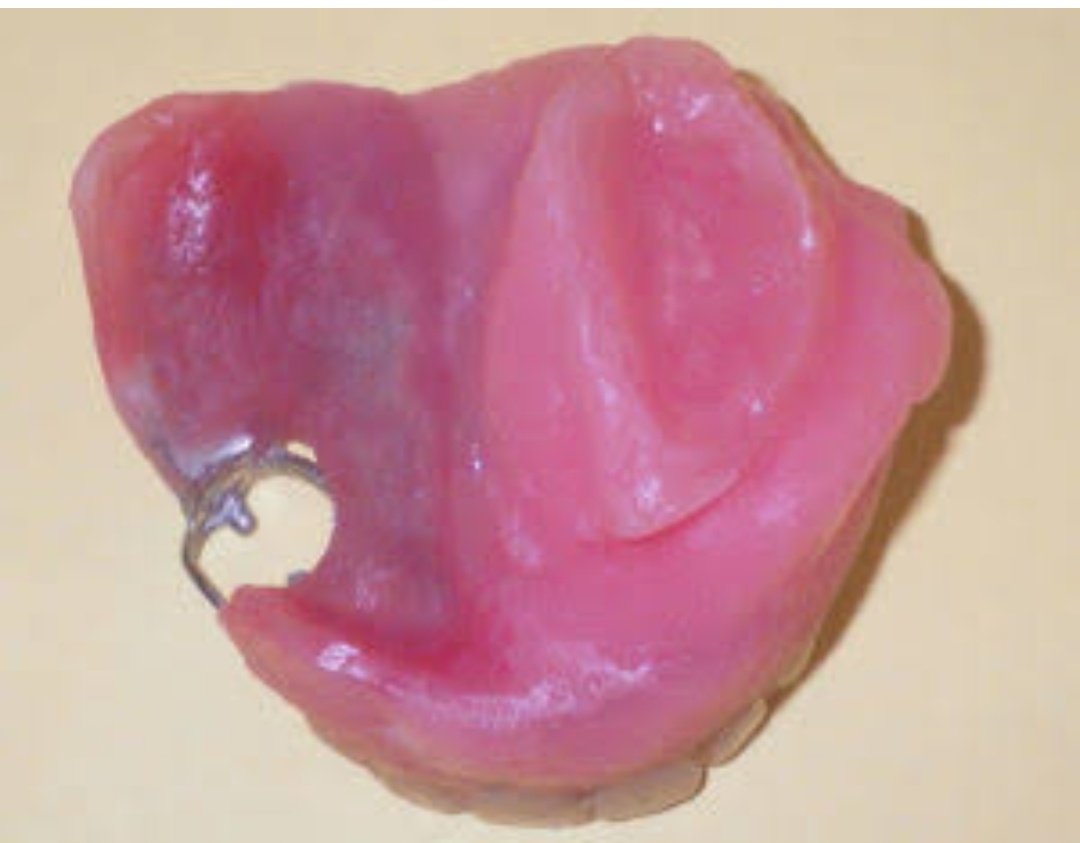 Doxing_7's tweet photo. Cleft Palate Obturator 🦷✨
An obturator is more than just a prosthesis—it creates a functional bridge where anatomy has left a gap.
By closing the palatal defect, it can help a cleft-palate patient with feeding, swallowing, speech, and separation of the oral and nasal cavities.
For many children, it becomes an important aid while they await definitive surgical correction. 
#Cleftlip #Cleftpalate