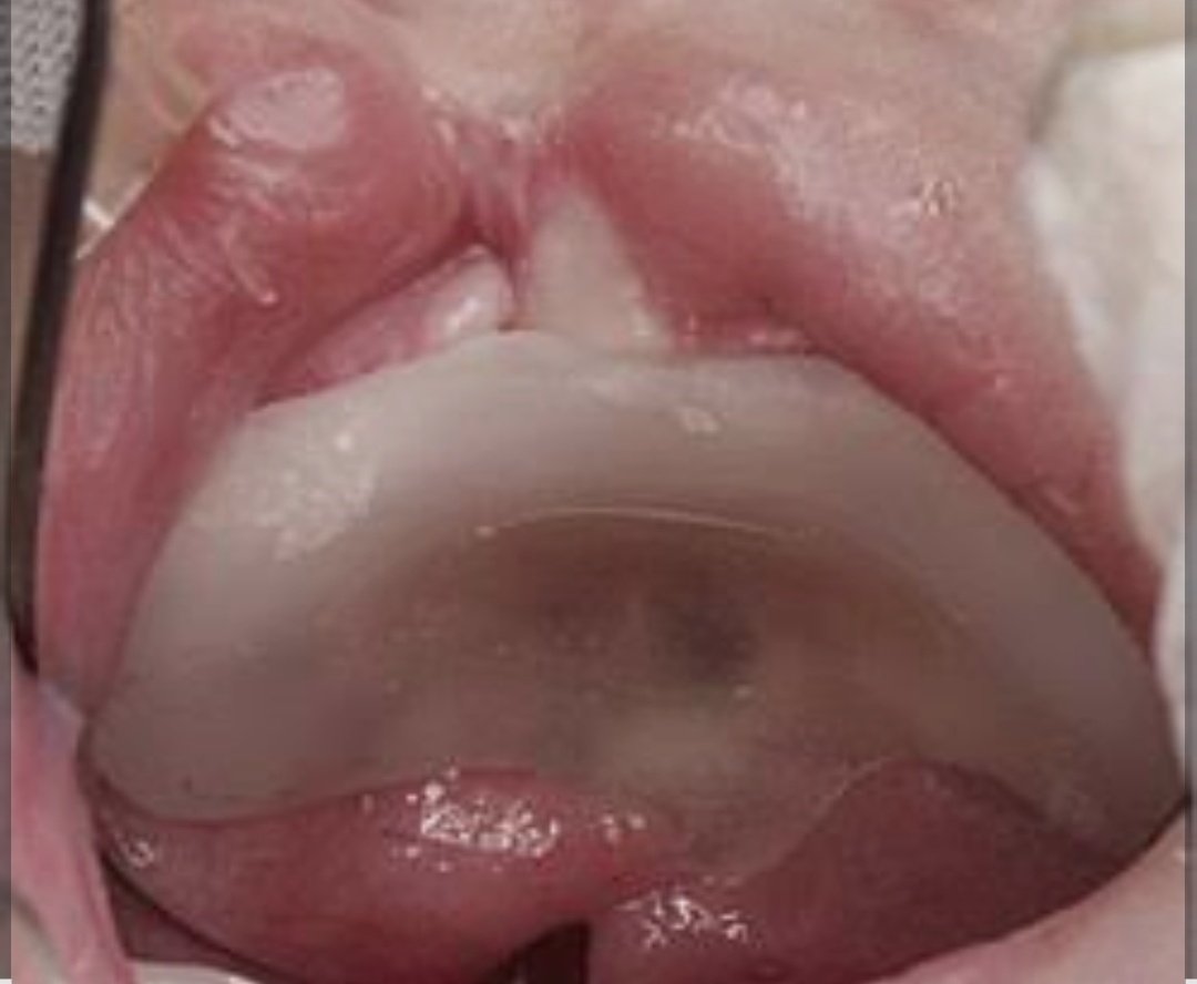 Doxing_7's tweet photo. Cleft Palate Obturator 🦷✨
An obturator is more than just a prosthesis—it creates a functional bridge where anatomy has left a gap.
By closing the palatal defect, it can help a cleft-palate patient with feeding, swallowing, speech, and separation of the oral and nasal cavities.
For many children, it becomes an important aid while they await definitive surgical correction. 
#Cleftlip #Cleftpalate