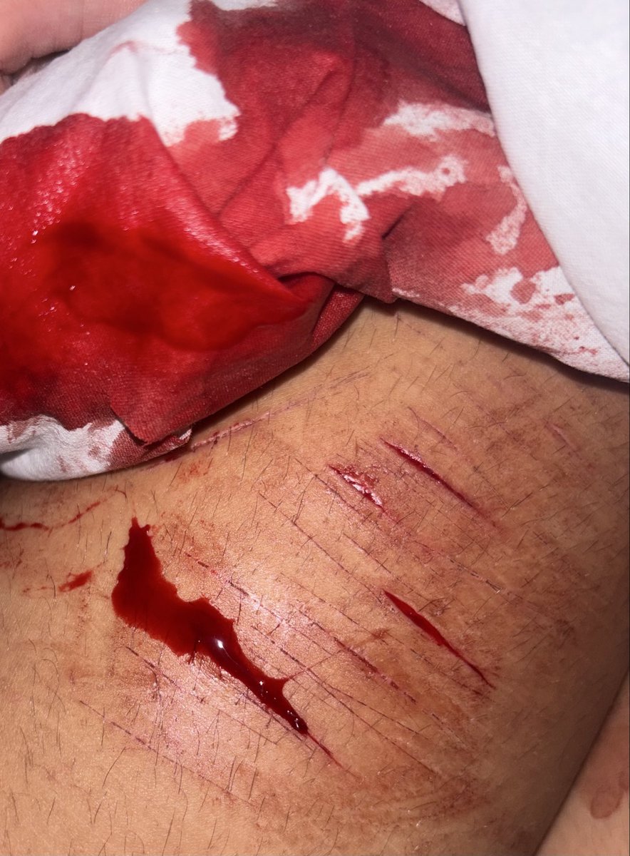 rir1_4bby's tweet photo. yesterday night i did some styros and they were bleeding like hell wtf is that normal? (SFX MAKE UP AI GENERATED!!) #shtwt https://t.co/EHERMP03qc