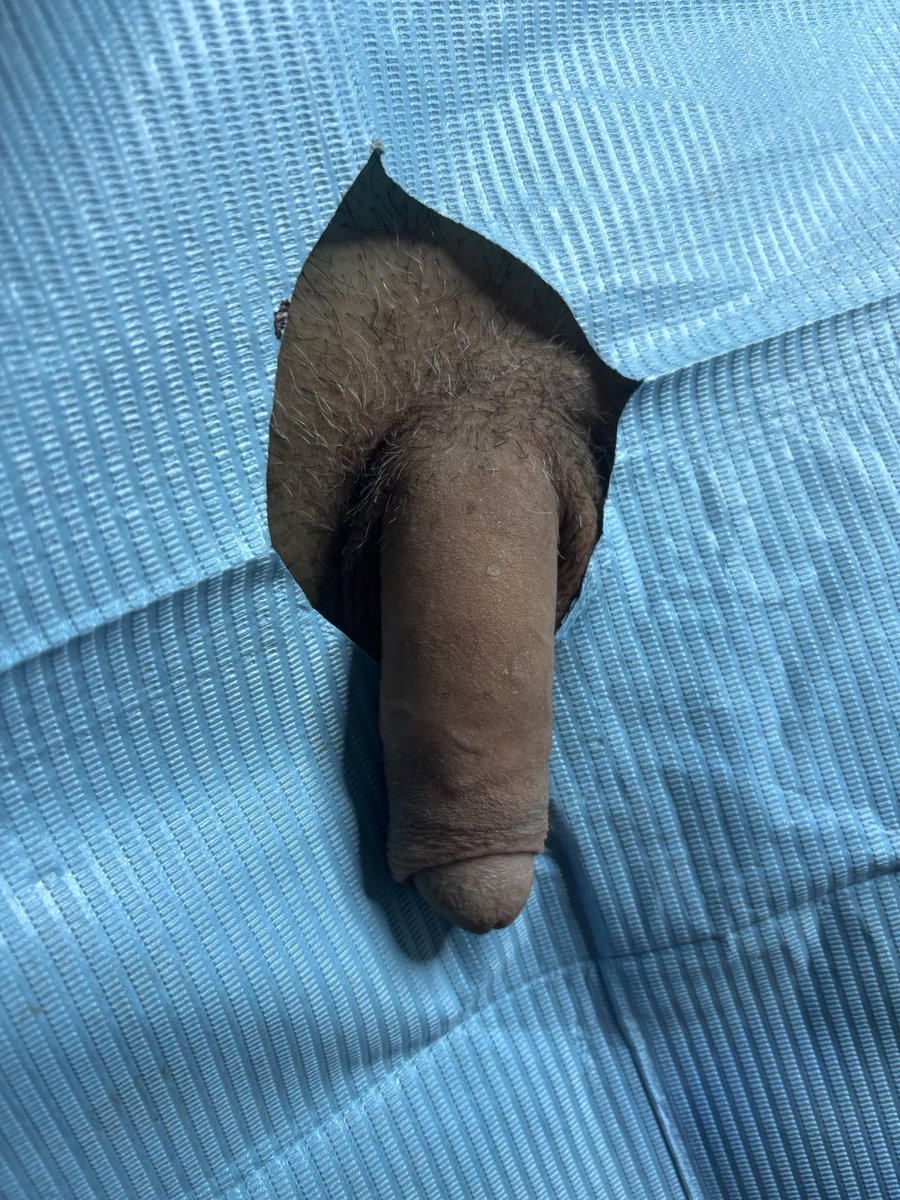 Doctora_pao's tweet photo. Les traigo otro caso de engrosamiento de pene 🙌✨ Mi pacientito vino a consulta queriendo más grosor! Que se sienta como entra al momento de las relaciones!! 🔥🔥🔥
El efecto de peso del ácido hialurónico hace efecto de peso haciendo que el pene se vea más largo 💪 #faloplastia https://t.co/Z22eI6mpxY