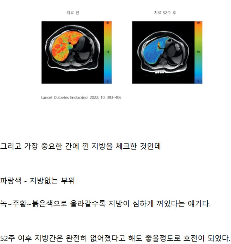 Dangerplanet's tweet photo. [정보] 마운자로를 맞고 살이 어떻게 빠지는지 추적관찰한 결과 https://t.co/WW64uORqMJ

예전에도 한 이야기지만 이건 진짜 안쓸 이유가 없는 약이라 공리적으로 엄청나게 이득인데 죽어라 틀어막는 이유를 알 수가 없다니까.

살인약은 열정적으로 풀어주고 싶고
가망없는 탈모약은 의보주고? https://t.co/uGZ6Dkg89c