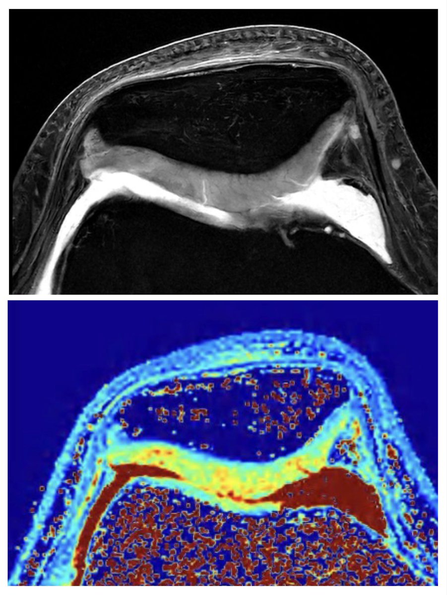 balvarezdsierra's tweet photo. ⏳ 10 days to #BAIS2026 • Anterior knee pain in an athlete: looking beyond morphology with high-resolution MRI + quantitative T1ρ mapping to assess patellofemoral cartilage.

More athletes, more joints, more advanced imaging.

📍 Barcelona | Oct 1–2 https://t.co/Oqt3BHXThU
