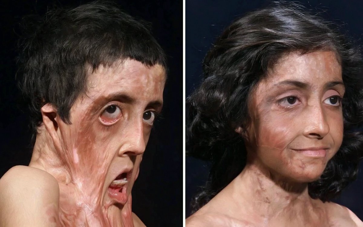beckertrudc4's tweet photo. Burn victim gets facial reconstruction
#ProtectWildlife #MrFanboyEP4 https://t.co/6jD4qtkHNM