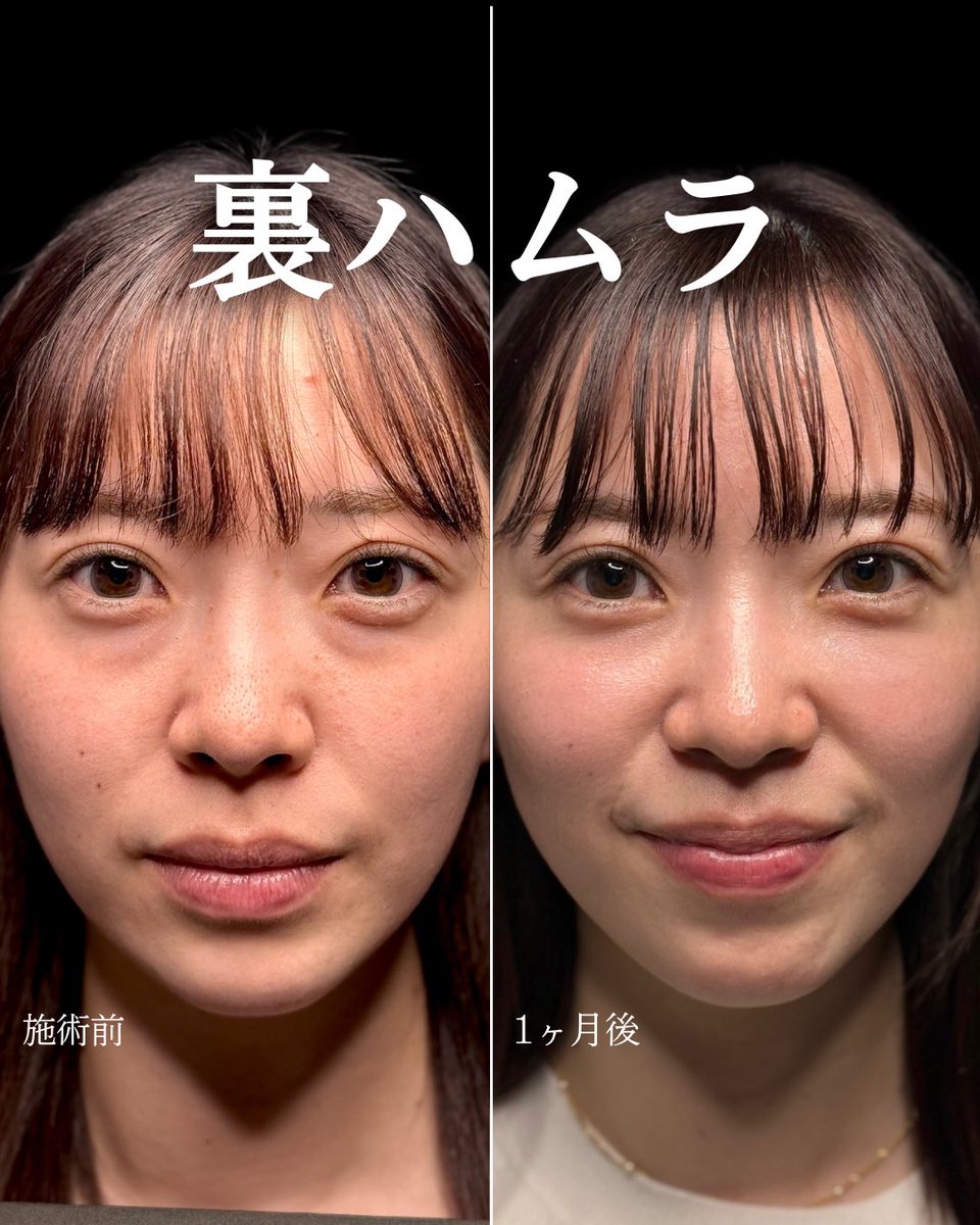 superriichikun's tweet photo. もう何回も言わせないで。

目の下に線がある人に脱脂はマジでやめて😢

クマ取り後にガイコツみたいな顔になってしまったというご相談が増え続けています。

この線の原因は"靭帯"です。
脱脂でも注入でもこの線は絶対に治りません。

唯一の治療法は"ハムラ法"です。
靭帯を剥離してそのスペースを眼窩脂肪で埋める。
それ以外の治療は現時点では存在しません。

目の下のクマ取りは初期治療を間違えると結果は悲惨です。
クマ取りのカウンセリングは全ての方法でできる医師を指名して行きましょう。

ドクター選びの参考になれば幸いです。