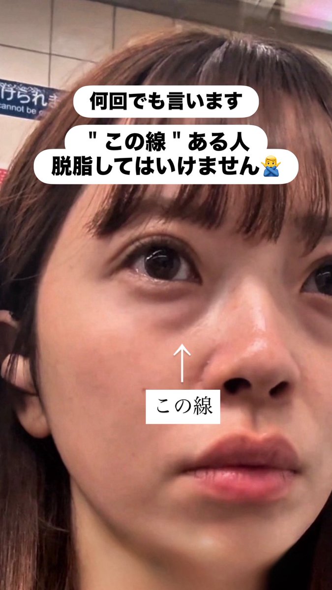 superriichikun's tweet photo. もう何回も言わせないで。

目の下に線がある人に脱脂はマジでやめて😢

クマ取り後にガイコツみたいな顔になってしまったというご相談が増え続けています。

この線の原因は"靭帯"です。
脱脂でも注入でもこの線は絶対に治りません。

唯一の治療法は"ハムラ法"です。
靭帯を剥離してそのスペースを眼窩脂肪で埋める。
それ以外の治療は現時点では存在しません。

目の下のクマ取りは初期治療を間違えると結果は悲惨です。
クマ取りのカウンセリングは全ての方法でできる医師を指名して行きましょう。

ドクター選びの参考になれば幸いです。