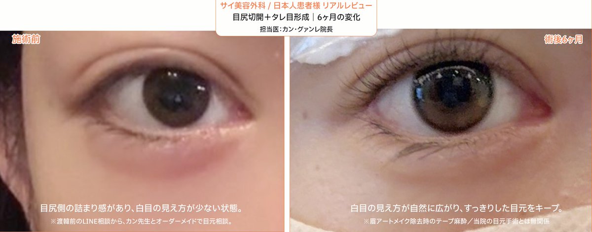sai_psclinic's tweet photo. 目尻切開＋タレ目形成｜術後6ヶ月
※実際の日本人患者様の症例

「タレ目形成、やりすぎ・後戻りが心配」という方へ。
目尻側の詰まり感を、骨格と白目バランスに合わせて自然に調整。
6ヶ月後も、すっきりした白目の見え方と自然なカーブをキープ。

渡韓前写真相談から 
📩https://t.co/aGuq0uGPZf https://t.co/Zhgv5MYd5O