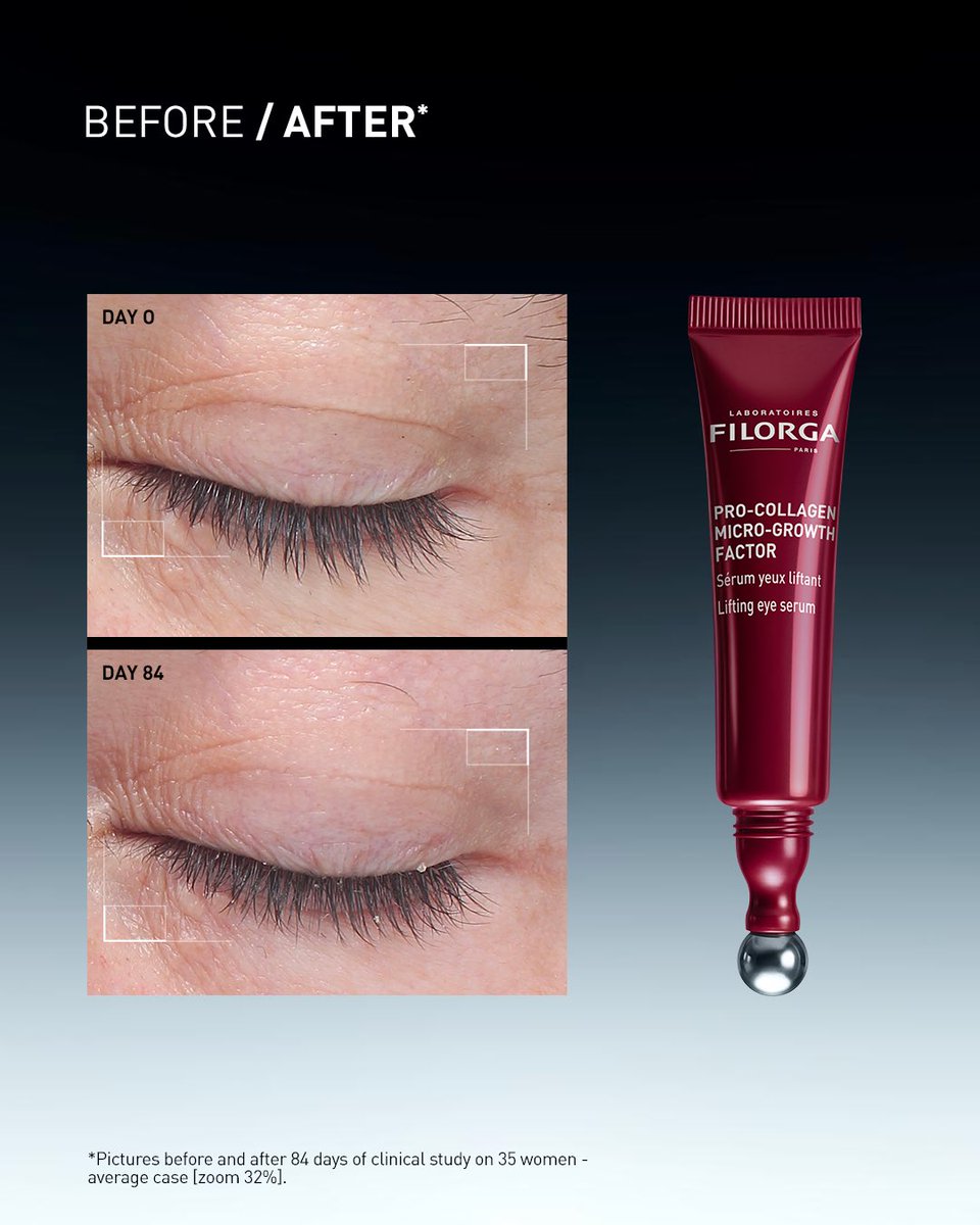 FilorgaSA's tweet photo. Real science, visible transformation. 

Swipe ➡ to discover the clinical results of our new Pro-Collagen Micro-Growth Factor routine 🧬. 

Proven efficiency to target loss of firmness and redefine your facial contours.

  📌 Save this post to track your own firmness journey! https://t.co/6w4BV0MNWy