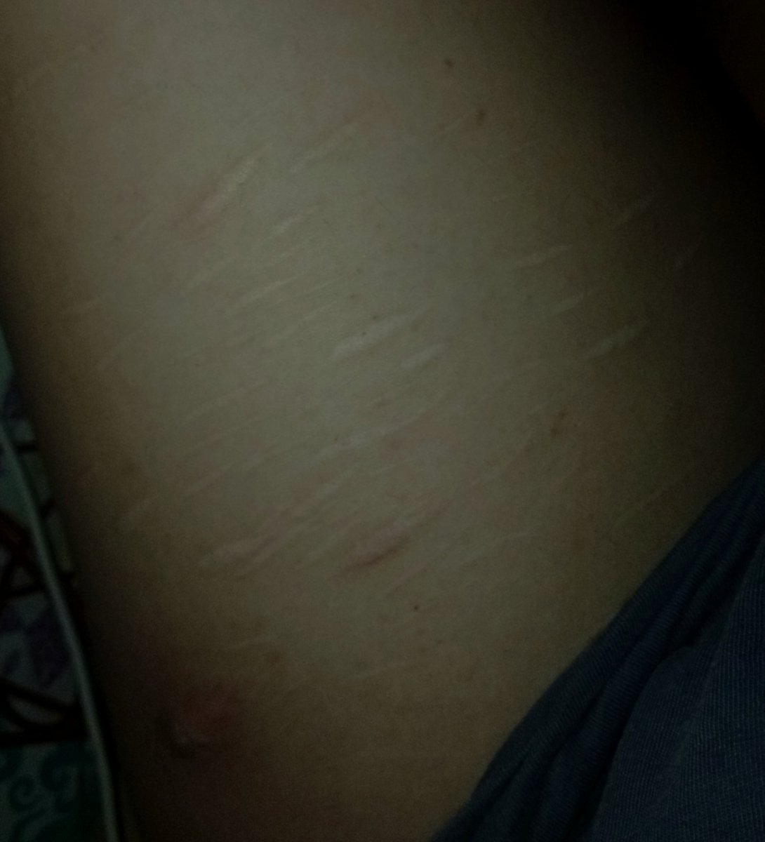 styrozzz_'s tweet photo. all of my scars 👀👀 ignore fatty mc fat thighs https://t.co/CYfXYzAqfW