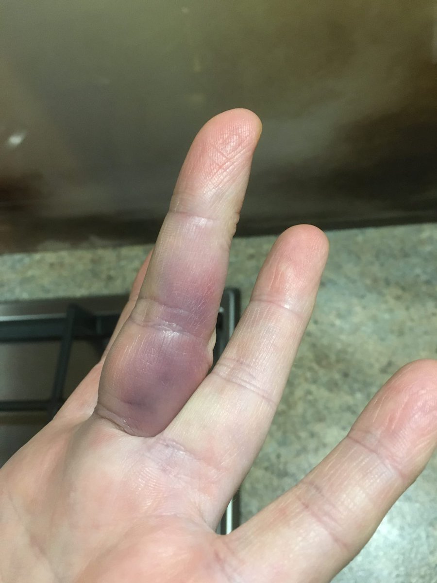 pamdonna_'s tweet photo. Sorry guys, I had a little accident during the weekend and I’ve been unable to handle the phone to keep it. Fractured my fingers, but it’s all good. Missed you https://t.co/DNvl7nlrbc
