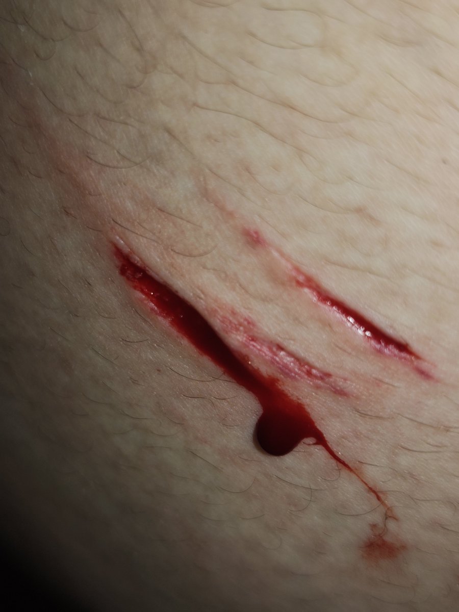 itsFishwithgues's tweet photo. Can someone tell if this is baby styro or tf this is. I've been clean for idk 2 years and I'm a pussy so I've never gotten this deep before 

SFX MAKE UP ALL FAKE AND FOR SFX MAKEUP PRACTICE ONLY

#shtwt #sh #sfxmakeup #selfharm https://t.co/73jOGXpwmX