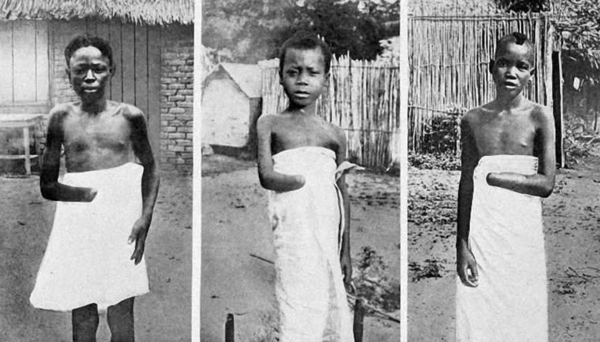 SankaraDispatch's tweet photo. King Leopold II of Belgium did this to innocent children in the Congo.

From 1885 to 1908, he ruled the Congo Free State as his personal possession—not as a Belgian colony, but as a private empire built on the extraction of ivory and rubber.

Congolese communities were subjected to forced labour and brutal rubber quotas.

Those who resisted or failed to meet them faced collective punishment. Villages were burned, people were killed, women and children were raped and taken hostage, and soldiers were notorious for cutting off the hands of victims.

The human cost was catastrophic. Over 10 Million innocent Congolese people were killed during Leopold's rule. 

They died through executions, forced labour, starvation, disease and exhaustion.

Missionaries and other witnesses documented the atrocities and helped expose what was happening. 

International outrage eventually became so intense that Belgium was forced to take control of the Congo Free State in 1908.

Leopold died the following year.

He was buried in the Church of Our Lady of Laeken, in Brussels. Yes, a Church ! 

And here is the craziest audacity: Belgium continued to honour him with monuments.

There have been Leopold II statues and memorials in Brussels, Ostend, Arlon, Antwerp and Ghent, among other Belgian locations.

Even more disturbing, the Brussels monument was made from copper and tin stolen from the Congo itself.

Some monuments have since been removed. 

But the fact remains:

A man whose regime presided over the deaths and devastation of millions of Congolese was turned into a national symbol and celebrated with statues across Belgium.

Imagine the audacity.

Europe remembers the buildings Leopold financed.

The Congo remembers the hands, the bodies and the children. 🇨🇩