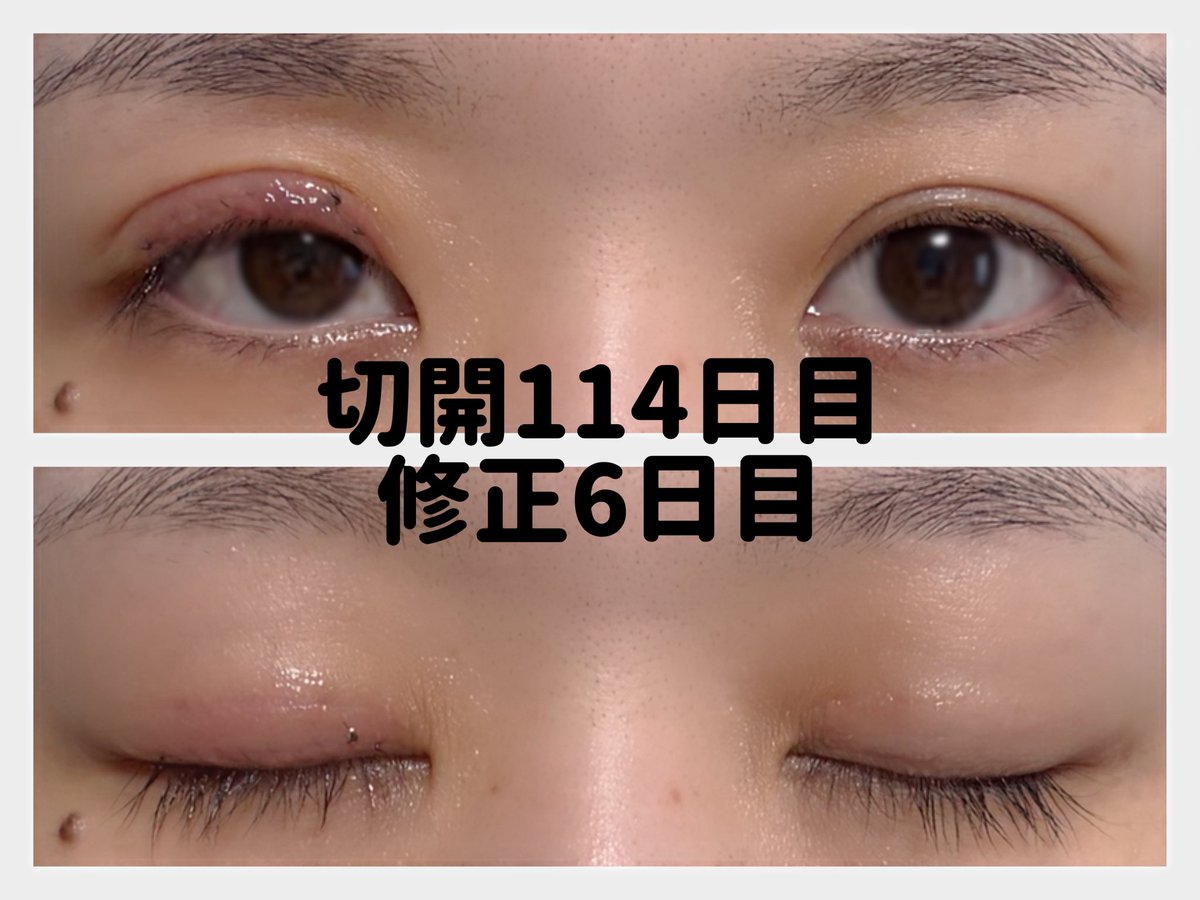 pppichan_seikei's tweet photo. 切開114〜116日目
修正6〜8日目

抜糸に行ってきたけど、もうずっと傷口痛くて消毒から抜糸も涙止まらなかった
余裕で二重切開より痛い
1週間くらいで腫れは引くらしいけどほんまか https://t.co/xc0BC1cKPq