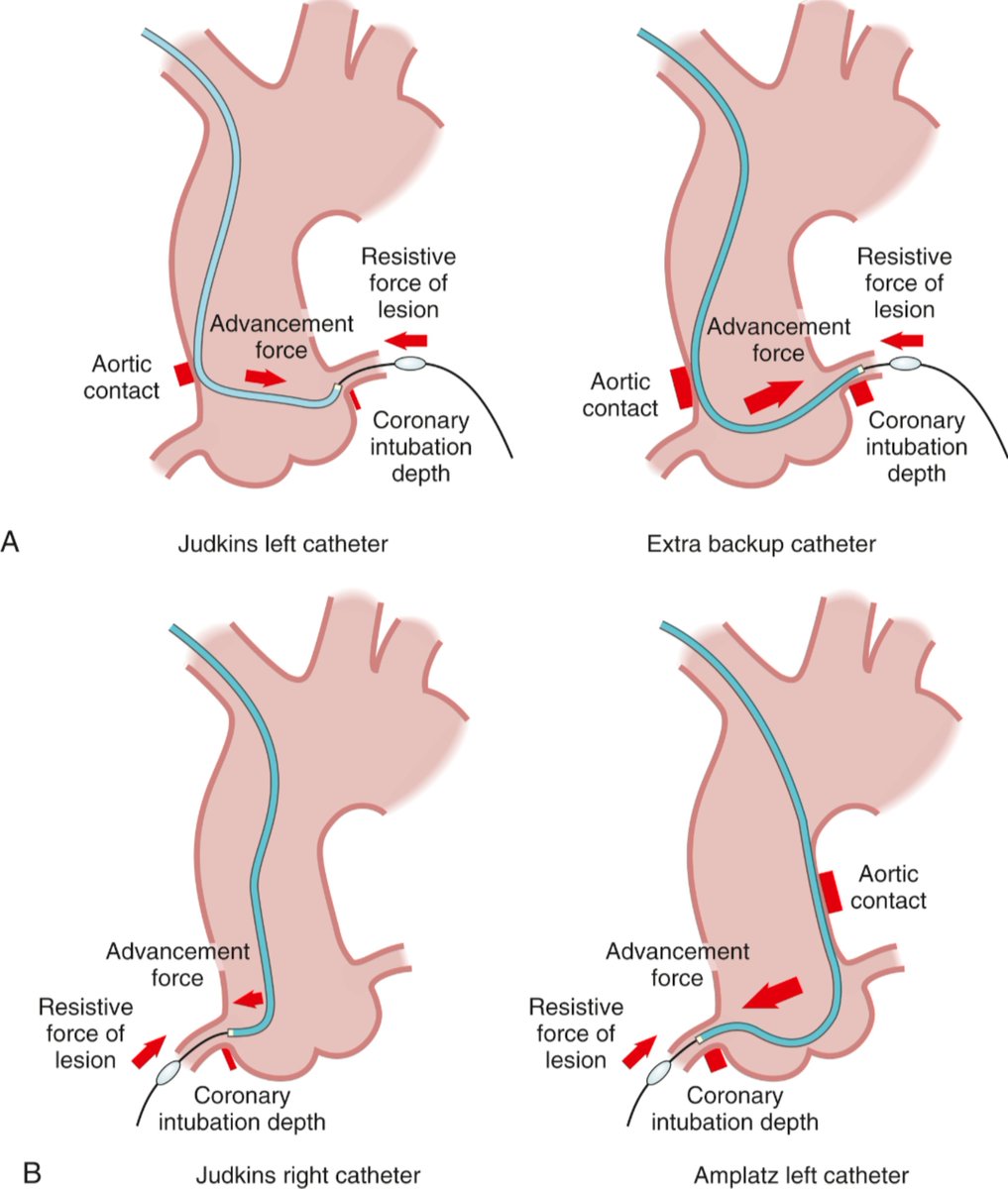 TrackYourHeart's tweet photo. Choosing the Guide Catheter

A good guide catheter does more than deliver devices.
It creates the stable platform needed to cross difficult lesions, deliver balloons and stents, and perform complex PCI safely.

The key principle is:
Guide support = shape + size + anatomy + access site.

A larger French size generally provides greater passive support, but bigger is not automatically better. The guide must match the patient's artery and the planned intervention. Larger radial sheaths and guides increase the risk of radial artery occlusion. 

⭕ Left coronary artery
For difficult or calcified lesions, EBU, XB and CLS guide shapes can provide strong backup support because their secondary curve contacts the aortic wall while the tip engages the coronary ostium.

⭕ Right coronary artery
A Judkins Right (JR) guide is often sufficient for straightforward RCA PCI.

More challenging anatomy may require an Amplatz Left (AL) or another supportive shape, depending on the RCA takeoff and aortic root anatomy.

The guide should be coaxial with the coronary ostium. Poor alignment can reduce support and increase the risk of ostial injury or dissection. 

What about guide size?
6 Fr remains extremely versatile and can accommodate most PCI techniques.
Larger guides may be needed when the procedure requires greater lumen capacity, such as certain complex bifurcation techniques or simultaneous device delivery.

But the goal is not to choose the largest guide possible.

Choose the smallest guide that safely provides the support and device compatibility the procedure requires.

And if the guide still lacks support, options include guide extensions, buddy wires, anchoring techniques or carefully selected deep intubation. 

Guide selection is part of PCI strategy, not just catheter selection.

Source: Textbook of Interventional Cardiology, 8th ed., Eric J. Topol & Paul S. Teirstein.
