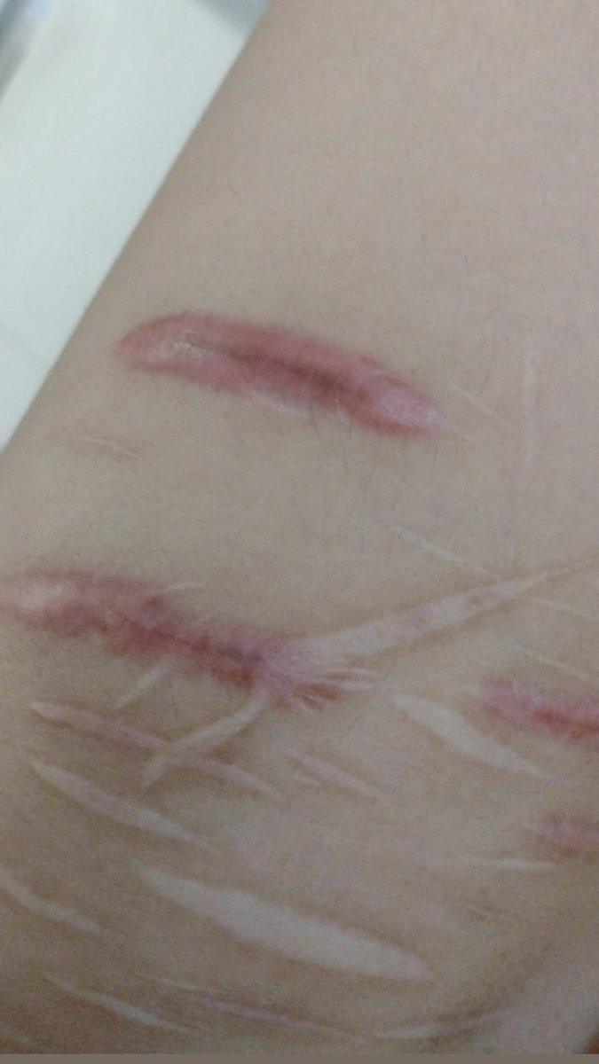 korystr's tweet photo. old pic of my scars :]
looking for moots 
#subtwt https://t.co/I8WTbTTRZJ