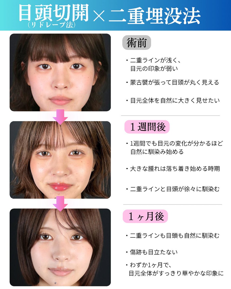 dr_maruyama's tweet photo. 【目頭切開リドレープ法の経過は？】 https://t.co/gu50uCGPU5