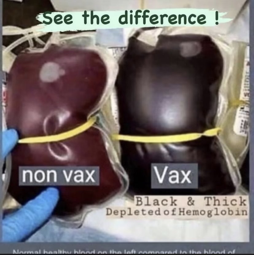 PanagiotisMylo6's tweet photo. Η PFIZER ΔΗΜΟΣΙΕΥΣΕ ΤΗ ΛΙΣΤΑ ΜΕ ΤΙΣ ΠΑΡΕΝΕΡΓΕΙΕΣ ΤΟΥ ΕΜΒΟΛΙΟΥ COVID🚨📣

1) Θρόμβος αίματος,
2) Οξεία νεφρική βλάβη,
3) Οξεία χαλαρή μυελίτιδα,
4) Θετικά αντισώματα κατά των σπερματοζωαρίων,
5) Εμβολή στελέχους του εγκεφάλου,
6) Θρόμβωση στελέχους του εγκεφάλου,
7) Καρδιακή ανακοπή (εκατοντάδες περιστατικά),
8) Καρδιακή ανεπάρκεια,
9) Θρόμβωση κοιλίας της καρδιάς...
10) Καρδιογενές σοκ,
11) Αγγειίτιδα του κεντρικού νευρικού συστήματος,
12) Νεογνικός θάνατος,
13) Θρόμβωση εν τω βάθει φλεβών,
14) Εγκεφαλίτιδα στελέχους του εγκεφάλου,
15) Αιμορραγική εγκεφαλίτιδα,
16) Επιληψία μετωπιαίου λοβού,
17) Επιληπτική ψύχωση,
18) Παράλυση προσώπου,
19) Σύνδρομο εμβρυϊκής δυσχέρειας,
20) Γαστρεντερική αμυλοείδωση,
21) Γενικευμένη τονικο-κλονική κρίση,
22) Εγκεφαλοπάθεια Hashimoto,
23) Θρόμβωση ηπατικών αγγείων,
24) Επανενεργοποίηση έρπητα ζωστήρα,
25) Επανενεργοποίηση καρκίνου...
26) «Turbo cancers» (επιθετικοί καρκίνοι ταχείας εξέλιξης),
27) Ανοσολογική ηπατίτιδα,
28) Διάμεση πνευμονοπάθεια,
29) Εμβολή σφαγίτιδας φλέβας,
30) Νεανική μυοκλονική επιληψία,
31) Ηπατική βλάβη,
32) Χαμηλό βάρος γέννησης,
Αλλά ναι... κατά τα άλλα...

ΝΑΙ, «είναι ασφαλή και αποτελεσματικά», σωστά...

Το μόνο μέρος αυτού του εμβολίου που είναι «αποτελεσματικό» είναι οι ΠΑΡΕΝΕΡΓΕΙΕΣ.

Ο Fauci είπε ψέματα και εκατομμύρια πέθαναν..!!
από Jimmy Bulger