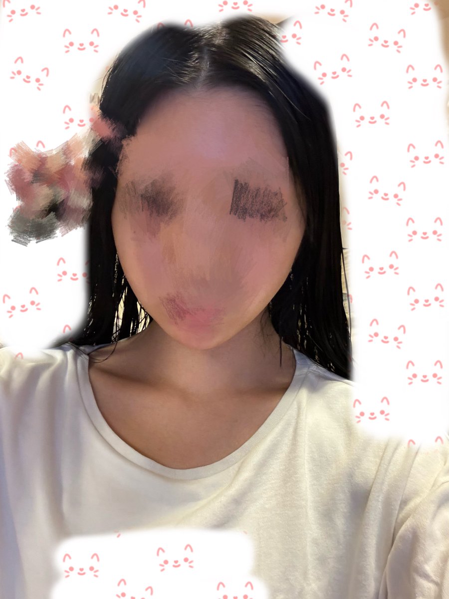 0f_ox0008's tweet photo. 糸リフトする前（左）と後（右、術後2日目とか）。
口横のもたつきが減った。
けど太ったから？orダウンタイムかわからないけど顔の丸みやばいから様子見てみる。
#整形垢 https://t.co/CZzcTvCFYH