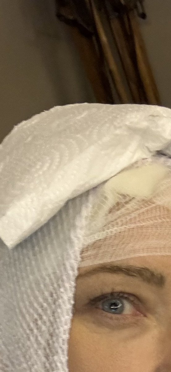 DidemArslanoglu's tweet photo. Dün eşimle birlikte yine tribündeki yerimizi aldık. Ortam yine coşku dolu, takım harika gidiyordu…

5. gol sevinciyle stat bir kez daha coştuğu sırada, arka sıramızdan elinde iki bardak KAYNAR su/çayla geçmekte olan çocuk yaşta sayılabilecek bir taraftarın bardaklarından biri başıma döküldü.

Sonrası; statta ilk yardım, Medicana Acil ve geceyi noktaladığımız Kartal Devlet Hastanesi Yanık Merkezi…

Buradan @Fenerbahce’mize önemli bir çağrım var:

Tribünlerde ağzı açık bardaklarla kaynar içecek servisi yapılmamalı. Sıcak içecekler daha düşük ısıda ve mutlaka güvenli, kapaklı karton bardaklarda verilmeli.

Dün o kaynar su benim başıma değil de küçücük bir çocuğun ya da bir bebeğin üzerine veya yüzüne gözüne dökülseydi??

Çok daha ağır sonuçlar doğmadan bu konuda önlem alınmasını talep ediyor ve yürekten umuyorum. 💛💙
#20Eylül #CumhuriyetinFeneri #ÖnlemŞart @mrarslanoglu @Fenerbahce