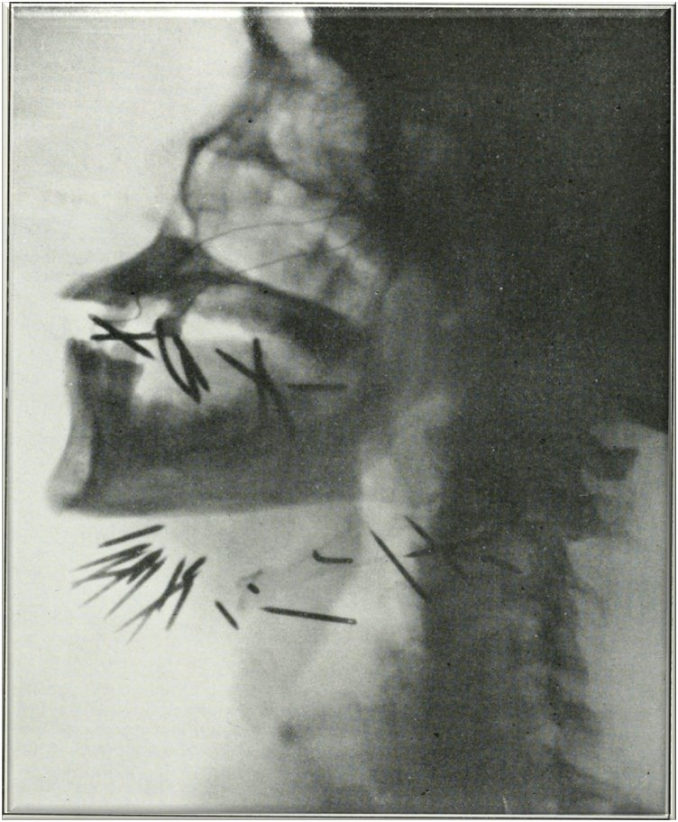 An X-ray image showing the side profile of a skull and neck. Multiple nails appear embedded in the jaw and neck area. The image is in black and white with varying shades of grey highlighting the bones and foreign objects.