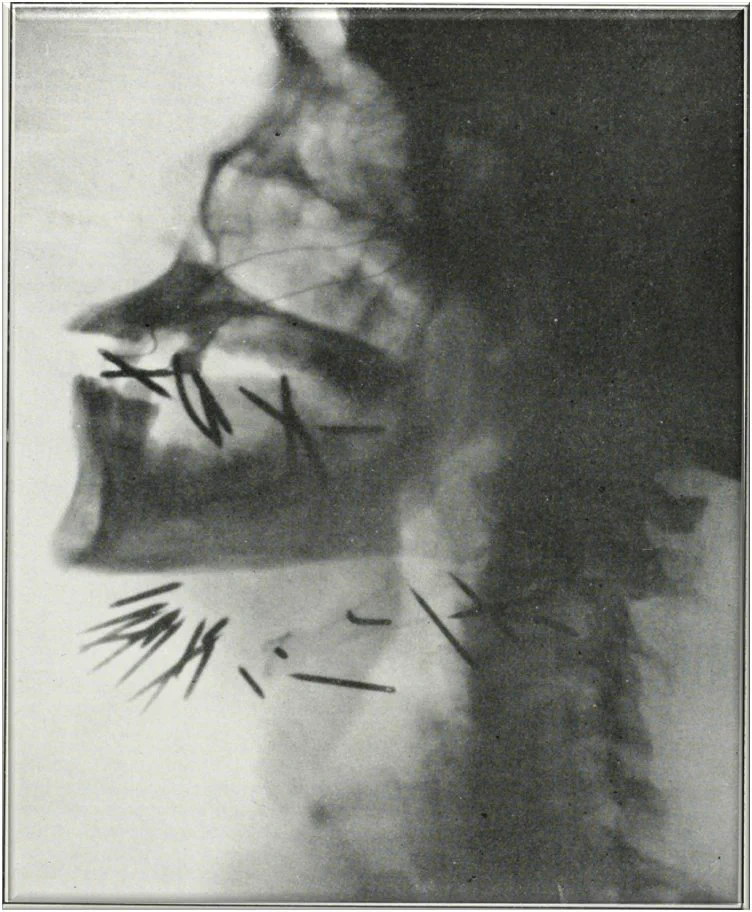 An X-ray image showing the side profile of a skull and neck. Multiple nails appear embedded in the jaw and neck area. The image is in black and white with varying shades of grey highlighting the bones and foreign objects.