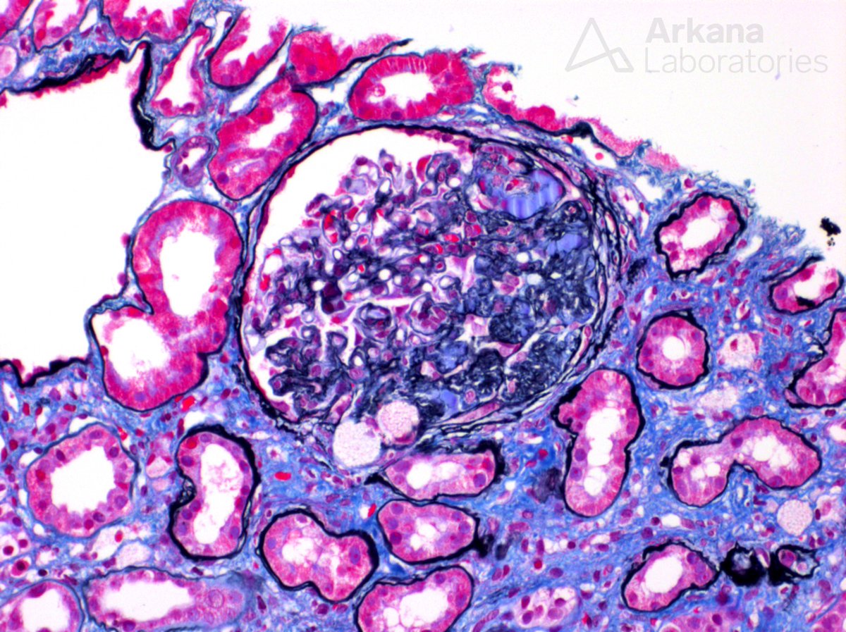 arkanalabs's tweet photo. The immunofluorescence study is negative. What is your diagnosis?

#DiagnoseThis #nephtwitter #pathtwitter #renal #kidneypath https://t.co/2NIh73SXv5