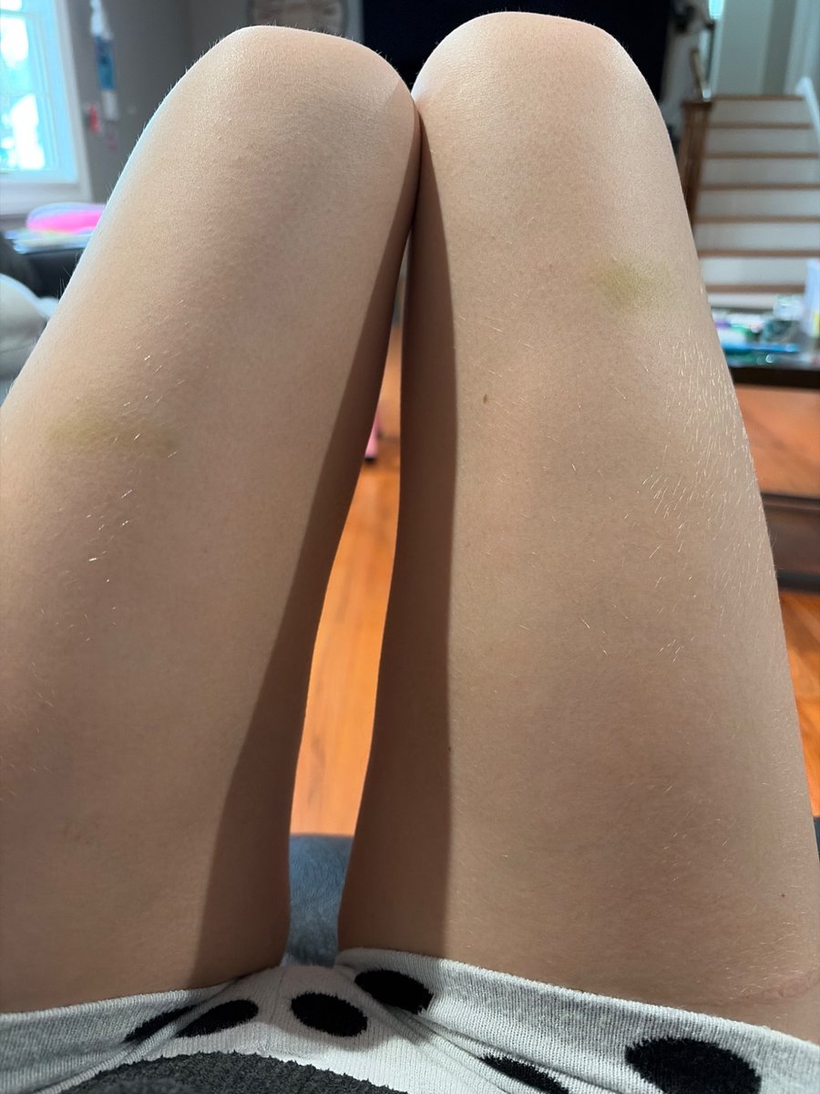 foxxlvr's tweet photo. just random bruises all over my thighs oh ok https://t.co/liQg17Xs1x