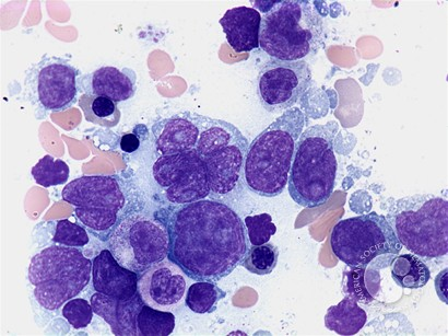 smbenlazar's tweet photo. Diffuse large B-cell lymphoma - bone marrow aspirate - | ASH Image Bank | American Society of Hematology https://t.co/YXYRf4fL5f #ASHImageBank https://t.co/quxx4F3ZYd