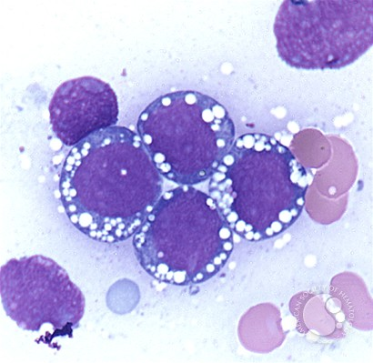 smbenlazar's tweet photo. Burkitt's Lymphoma | ASH Image Bank | American Society of Hematology https://t.co/HpctrQ1QtD #ASHImageBank https://t.co/Nry8STxl47