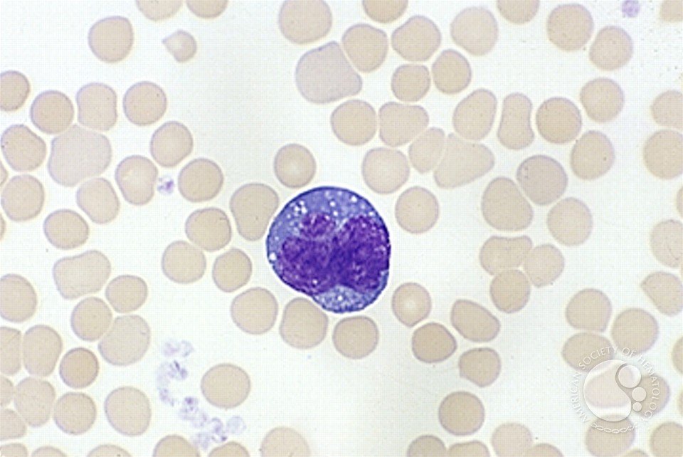 smbenlazar's tweet photo. Angioimmunoblastic T Cell Lymphoma | ASH Image Bank | American Society of Hematology https://t.co/T1zQXZc3xQ #ASHImageBank https://t.co/8vw4XxWLFL