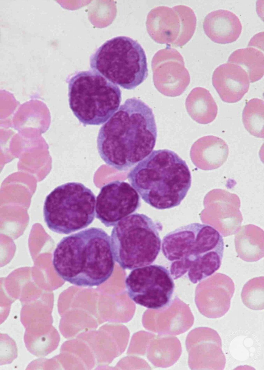 smbenlazar's tweet photo. Adult T-cell Leukemia/Lymphoma - | ASH Image Bank | American Society of Hematology https://t.co/nCyoCydDiZ #ASHImageBank https://t.co/wPSBjAeq4y