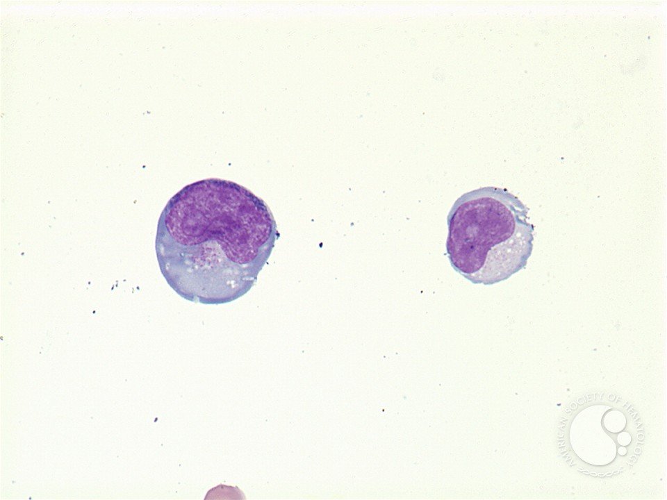 smbenlazar's tweet photo. Extranodal NK/T-cell lymphoma | ASH Image Bank | American Society of Hematology https://t.co/mKhPeCgTur #ASHImageBank https://t.co/eH7rgItUmn