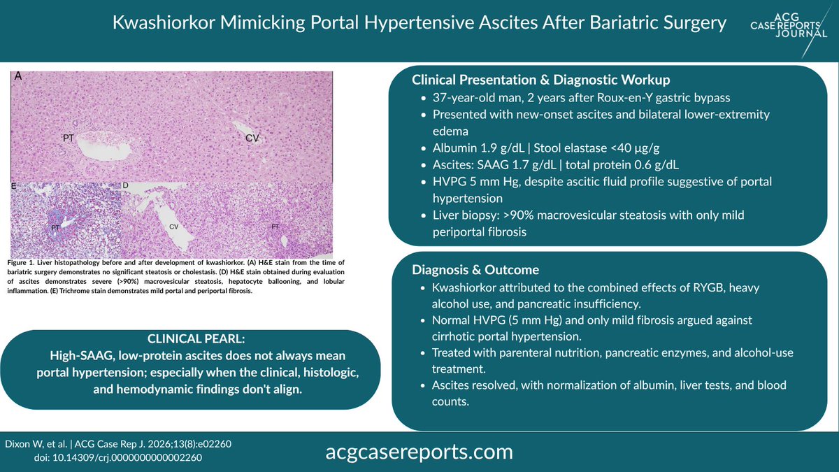 ACGCRJ's tweet photo. 🏆 Editor's Pick of the Month #ACGCRJ
Kwashiorkor Mimicking Portal Hypertensive Ascites After Bariatric Surgery

https://t.co/ldDyJZd3Ch

Not all high-SAAG ascites is portal hypertension: kwashiorkor after bariatric surgery can be a convincing mimic. https://t.co/rI78TypuOZ