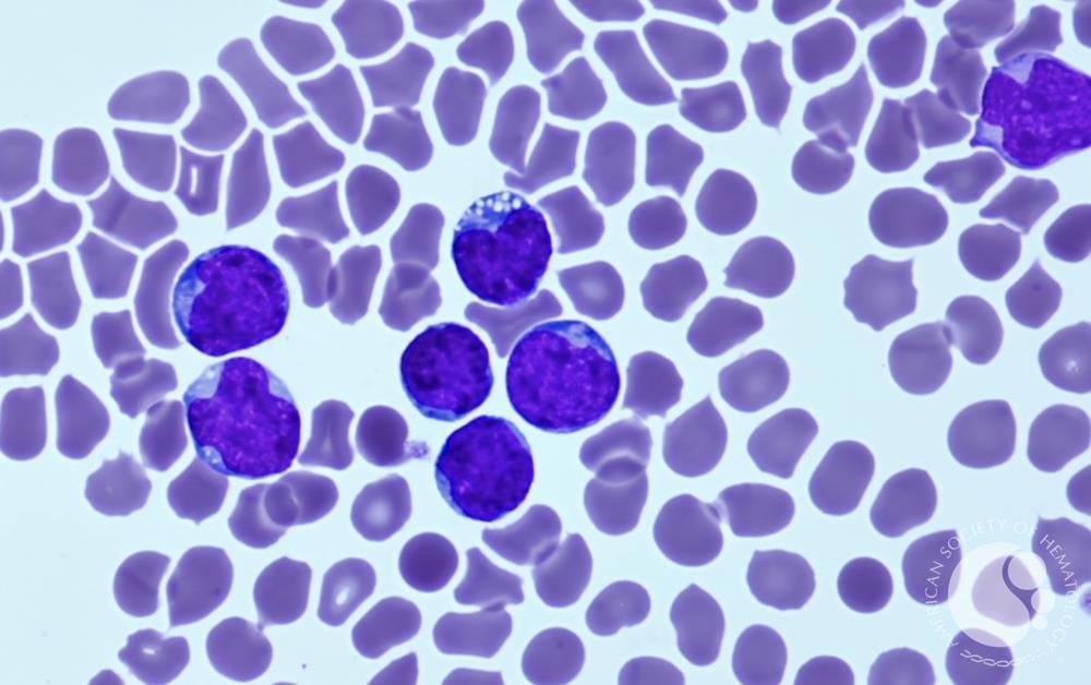 smbenlazar's tweet photo. T-ALL blood film | ASH Image Bank | American Society of Hematology https://t.co/VTIYQ5I1kE #ASHImageBank https://t.co/0Pqb9ZMjf2