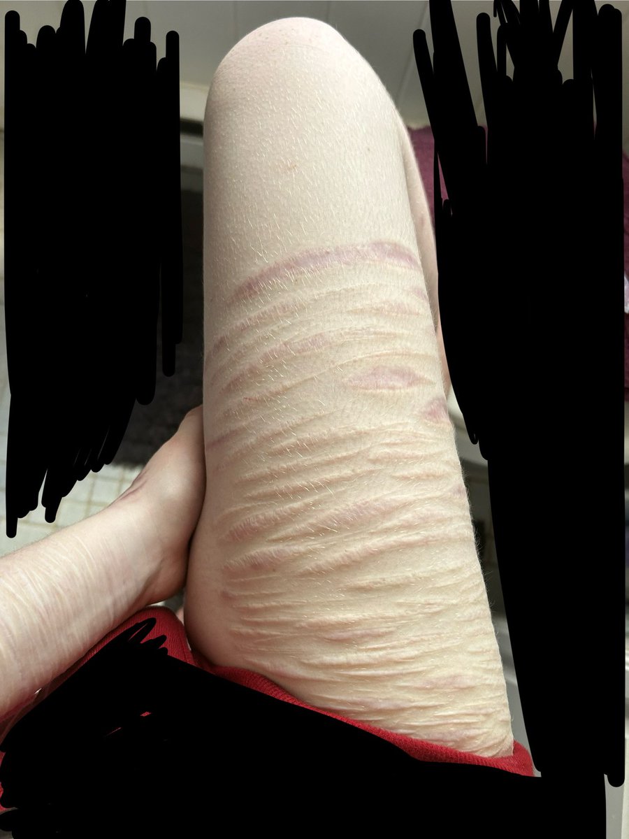 teethareboness's tweet photo. all fake ai enhanced sfx scars for medical teaching. upset when they fade; upset when theyre visible. #shrtwt #slittwt #beanstwt #raspberryfillingtwt #sillytwt #scars #sfx https://t.co/DCqSt54bj9