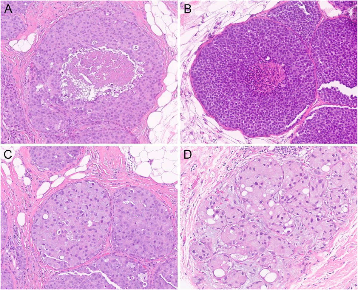 Human_Pathology's tweet photo. New in #HumPathol: Germline Cancer Predisposition Gene Mutations and Upgrade Rate to Breast Cancer Among Patients with Pleomorphic and Florid Lobular Carcinoma in Situ. https://t.co/yyfrU0t1C8 #pathology #PathTwitter #PathX #breastpath https://t.co/sNxDAKD8yh