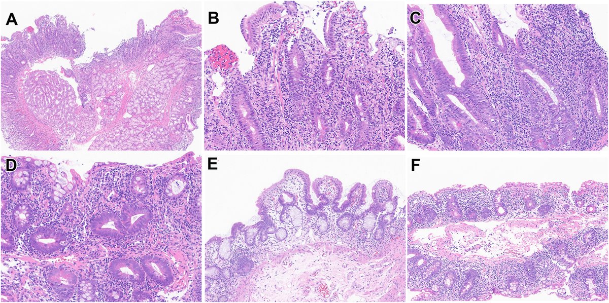 Human_Pathology's tweet photo. New in #HumPathol: Characterization of Histologic Spectrum and T-Cell Clonality in Immune Effector Cell-Associated Enteritis. https://t.co/vie1BVwBf5 #pathology #PathTwitter #PathX #GIpath https://t.co/u6LQvHI13c