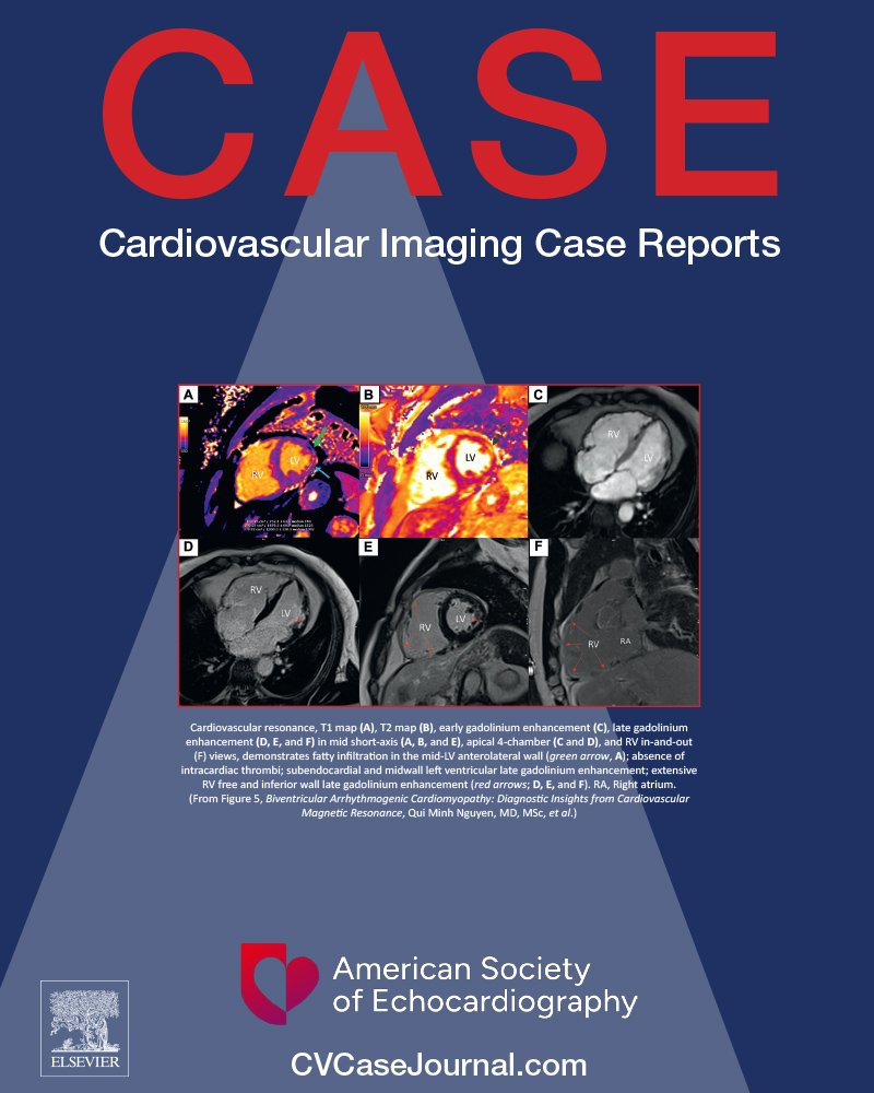 ASE360's tweet photo. Our September 2026 @CASEfromASE is online! https://t.co/1ByL5g1ouL

This issue features:
🫀Left Atrial Appendage Ostial Stenosis: A Case Series
🫀Biventricular Arrhythmogenic Cardiomyopathy
🫀Stenotic Persistent Right-Sided Fifth Aortic Arch with Fourth Arch Interruption https://t.co/rG9ikaYLsd