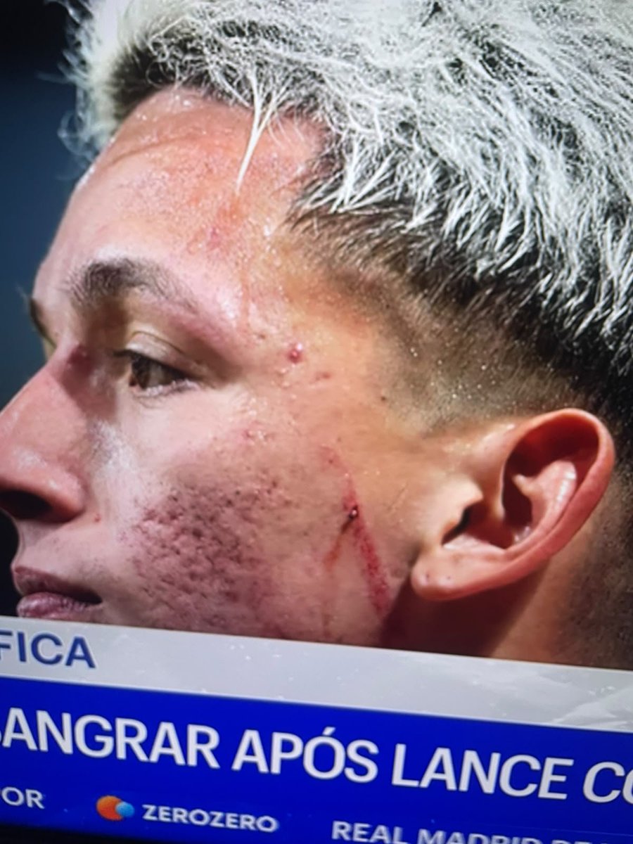 LuisMota1986's tweet photo. E não é que foi mesmo um problema de "acne" ? 🤣 https://t.co/gMjXKAtczb