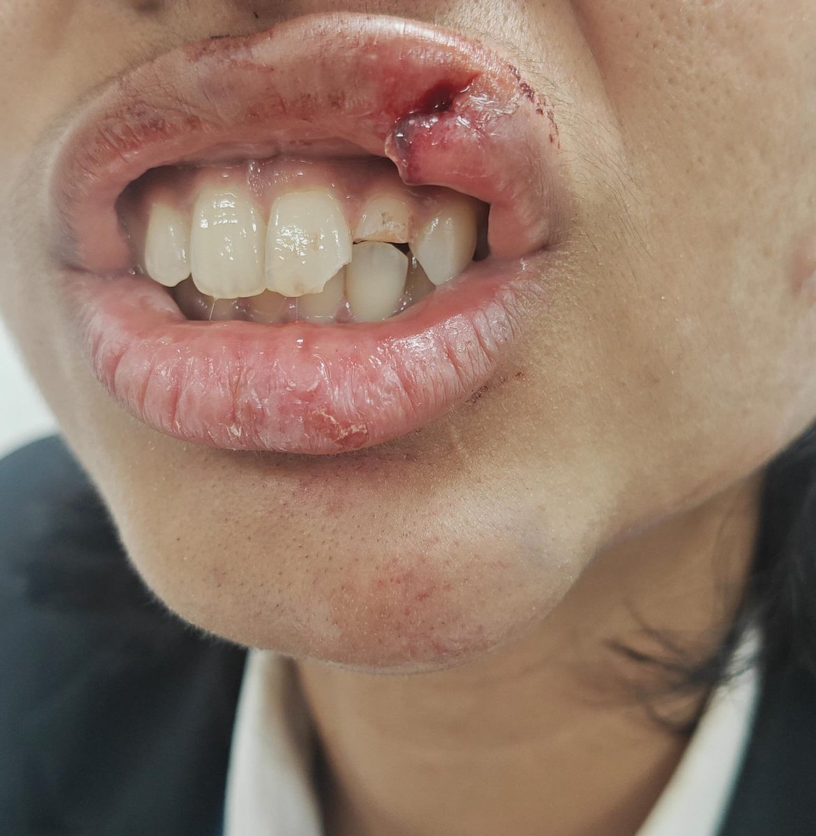HalderPiyal's tweet photo. @RapidoCares @ghaziabadpolice
@Gzbtrafficpol @dm_ghaziabad @rapidoapp_
Plz respond to my daughter's case (Snigdha Halder), who has met with an accident due to ur Rapido drivers fault on 18th at Ghaziabad. She is a Student of Jaipuria Inst of Management, Ghaziabad.
See attachments https://t.co/3eb0IxyWlq
