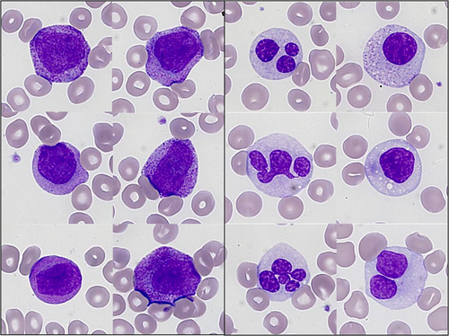 smbenlazar's tweet photo. Morphological characterization of acute myeloid leukaemia with t(11;17)(q23;q21)/ZBTB16::RARA fusion https://t.co/0CXtPO9t0L https://t.co/UyzyOym0BH