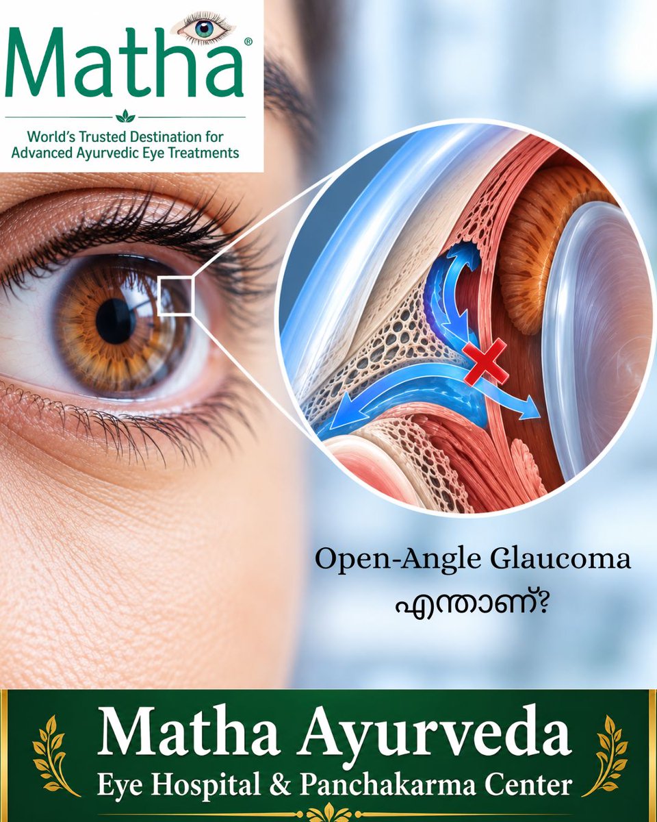 arunjithp's tweet photo. Open-Angle Glaucoma എന്താണ്?

കണ്ണിനുള്ളിലെ Aqueous Humor സാധാരണയായി drainage system വഴി പുറത്തേക്ക് ഒഴുകിപ്പോകണം. എന്നാൽ drainage angle തുറന്നിരിക്കുമ്പോഴും, ഈ fluid ശരിയായ വേഗത്തിൽ പുറത്തേക്ക് drain ചെയ്യാൻ കഴിയാതെ വന്നാൽ കണ്ണിനുള്ളിൽ fluid അടിഞ്ഞുകൂടുകയും Intraocular Pressure (IOP) വർധിക്കുകയും ചെയ്യാം. ഈ അവസ്ഥയാണ് Open-Angle Glaucomaയിൽ പ്രധാനമായി കാണുന്നത്.

ഈ pressure കാലക്രമേണ Optic Nerve-നെ ബാധിക്കുകയും കാഴ്ചയ്ക്ക് കേടുവരുത്തുകയും ചെയ്യാം.

Click here to watch>>>https://t.co/5sK7qRxpaJ