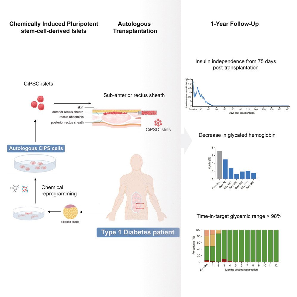 agingroy's tweet photo. A woman with type 1 diabetes stopped needing insulin 75 days after a transplant, and a year later, she still does not.

Type 1 diabetes happens because the immune system destroys the islet cells in the pancreas that make insulin. Transplanting islets from a dead donor has worked since 2000, but donors are scarce and the recipient has to take immunosuppressants for life.

The obvious fix is to grow islets from the patient's own cells. The obvious problem is that the standard method uses Yamanaka factors, delivered by a virus, including one that is a cancer gene.

This team skipped all of that. They reprogrammed her own cells back into stem cells with small molecules alone, with no virus and no Yamanaka factors, and then turned them into islets.

The surgeon placed them under the sheath of muscle in her abdomen instead of in the liver, where islets usually go, because a graft you can see on a scan is a graft you can cut out if it misbehaves.

Her time in the healthy glucose range went from 43% to over 98%.

One patient, published in @CellCellPress. She was already on immunosuppressants for a previous liver transplant, so this does not yet tell us whether autologous islets can escape the autoimmune attack that caused the disease in the first place.

This is an impressive proof of concept, but the real test is whether it works in patients who are not already immunosuppressed.