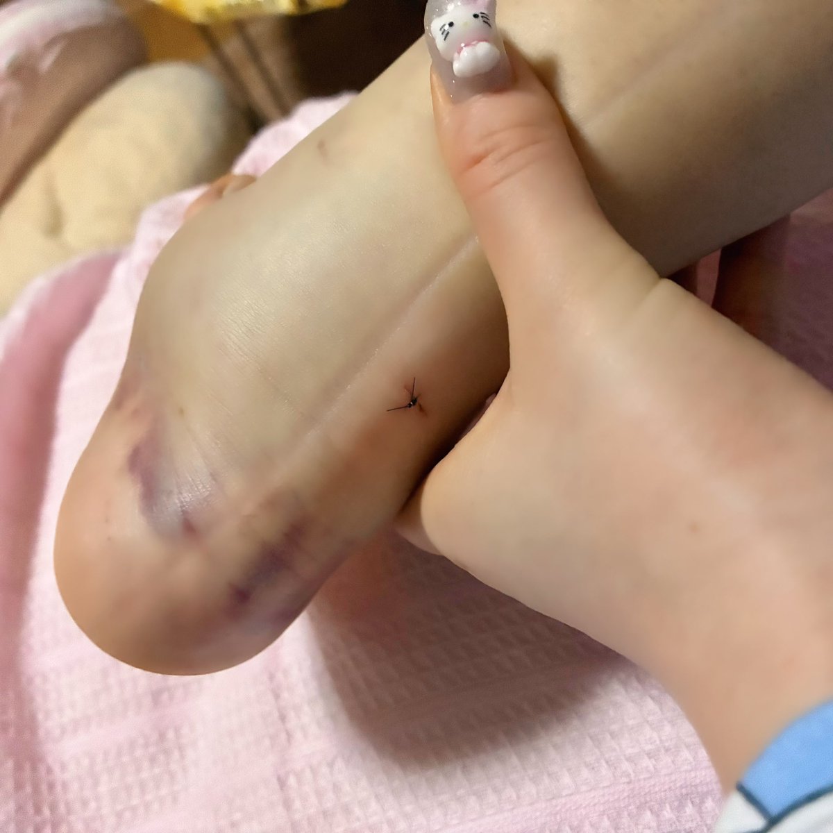 ふくらはぎ脂肪吸引の傷口は、なんと「かかと」にできました。
自分の手の大きさと比べるとこんな感じ。ここから脂肪吸引したみたいです。
思ってたより傷口がかなり小さくてびっくりした https://t.co/cNFjrJZ7T4
